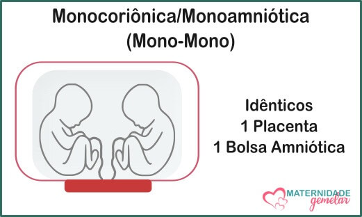 monocoriônica monoamniótica