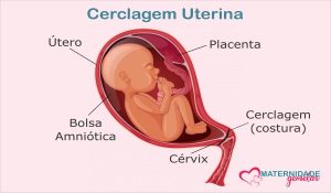 Cerclagem uterina - procedimento evita abortos e partos prematuros
